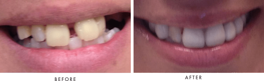 Before and after procedure photos