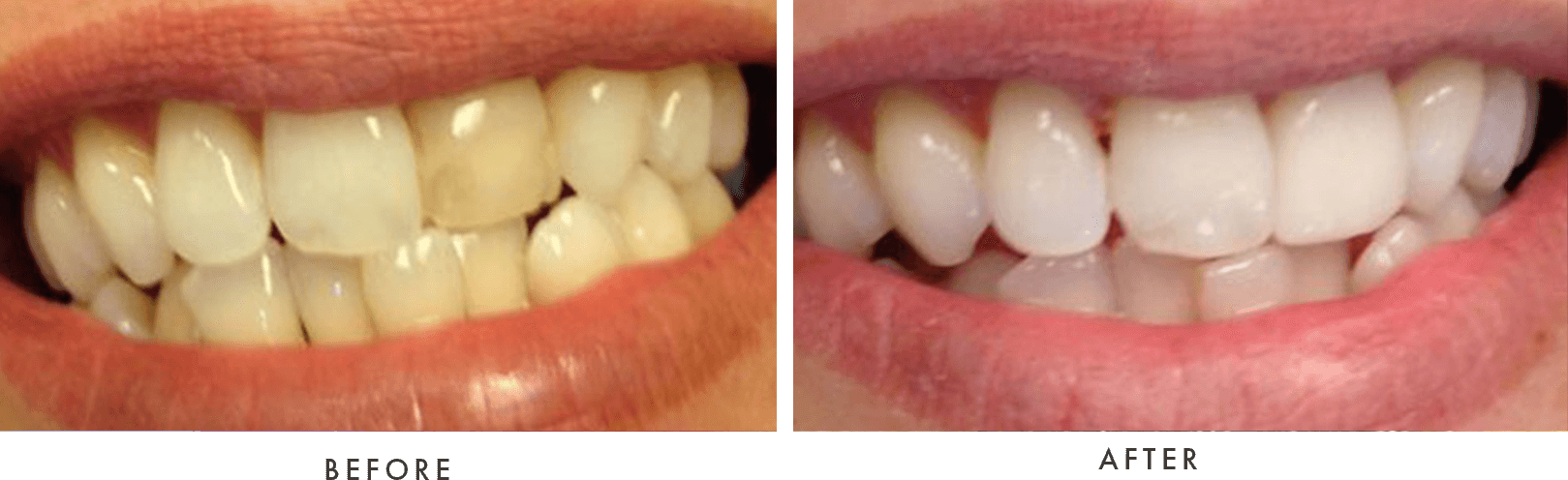 Before and after procedure photos