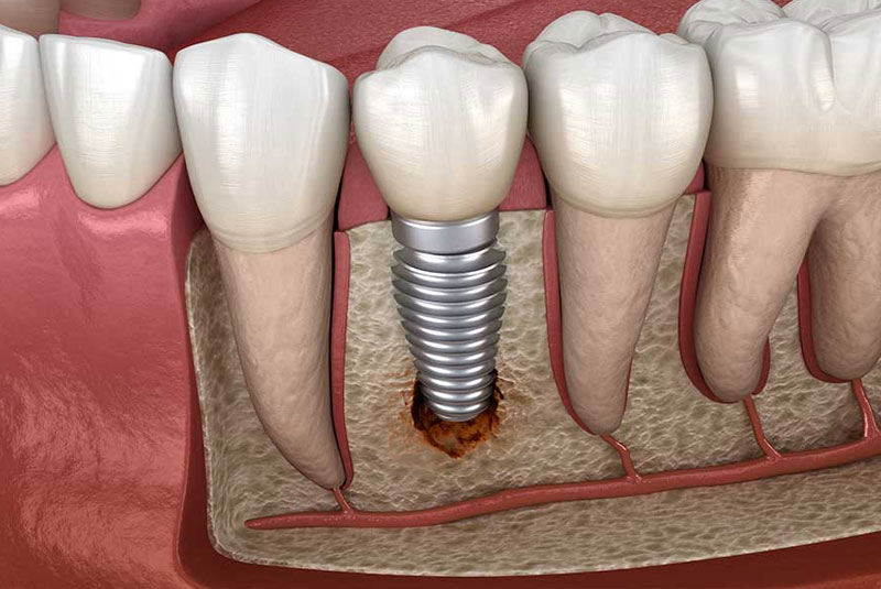 failing dental implant
