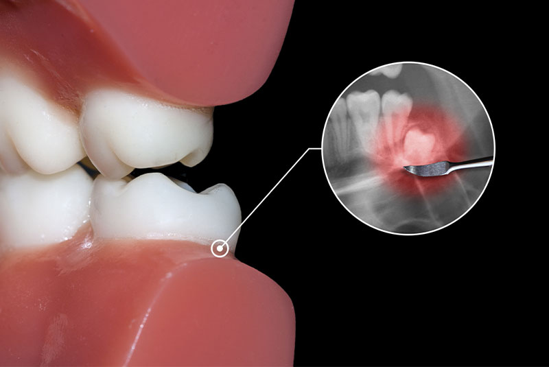 impacted wisdom tooth