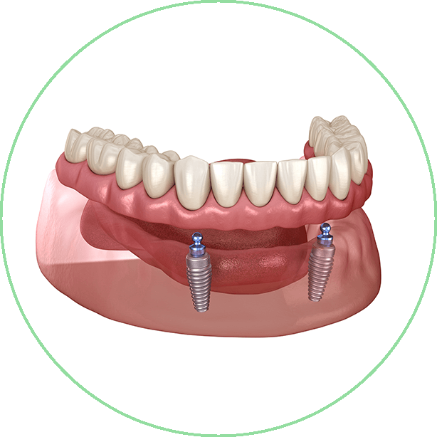 snap on dentures