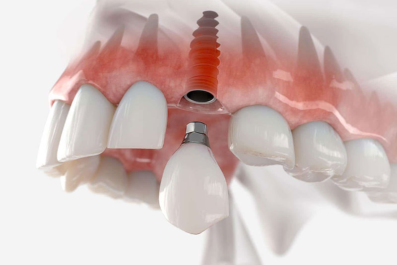 broken dental implant